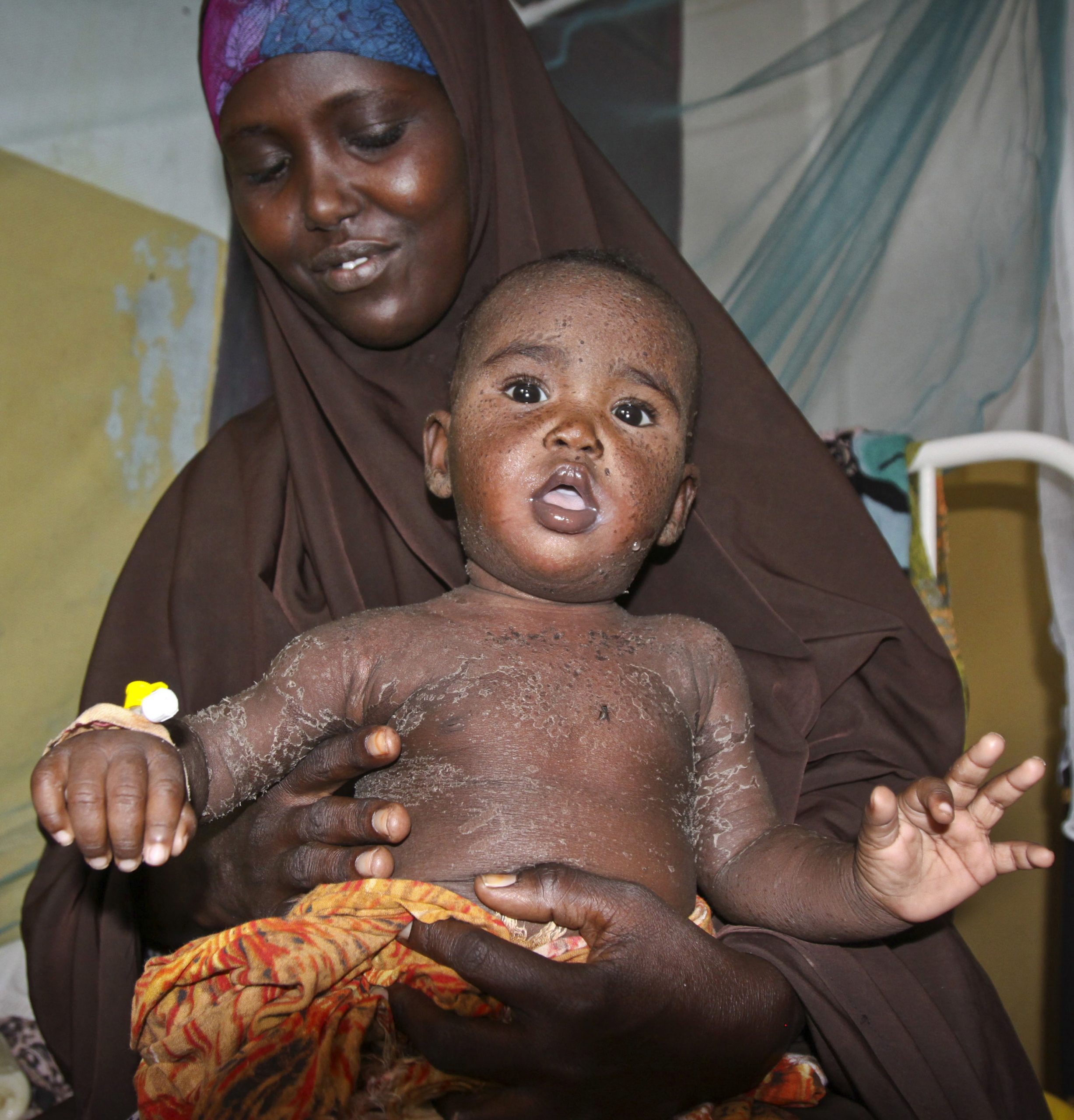 In Somalia, a wives’ tale delays measles treatment