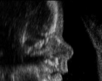 PolitiFact Can’t Get Its Story Straight on Romneycare and Abortion