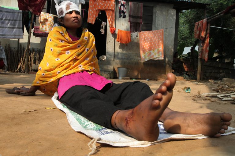   In this photo taken on Friday Nov. 29, 2012, Ratna Begum, a survivor of a garment factory fire, rests in her house in Dhaka, Bangladesh. Major retailers have disavowed the Bangladesh garment factory where 112 workers died in the fire last month, but the survivors of the fire have not. Factories like the one gutted on Nov. 24 are a rare lifeline in this desperately poor country, and now many of the more than 1,200 surviving employees have no work and few prospects. (AP Photo/ Ashraful Alam Tito)  