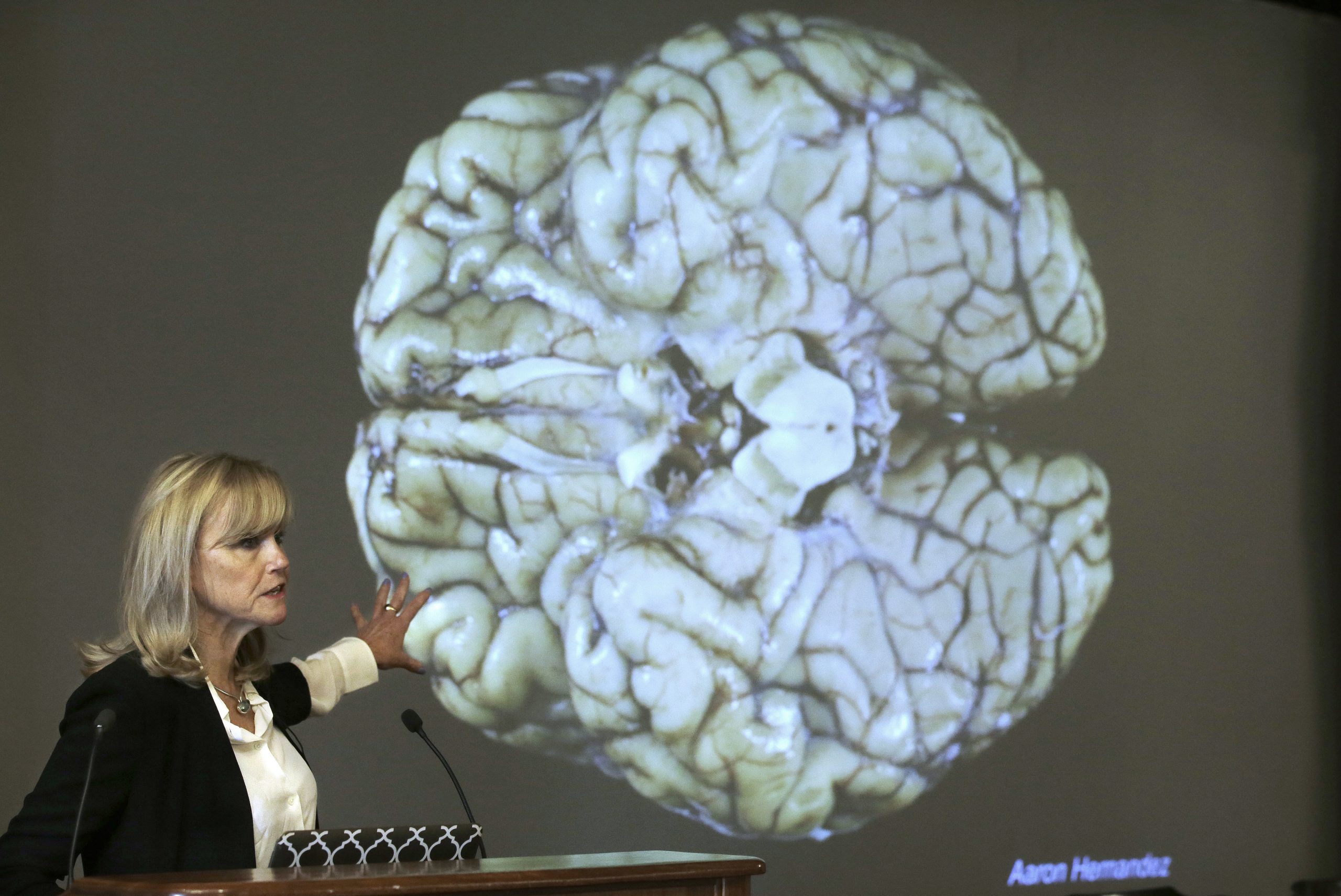 Causal link between head trauma and CTE established for first time