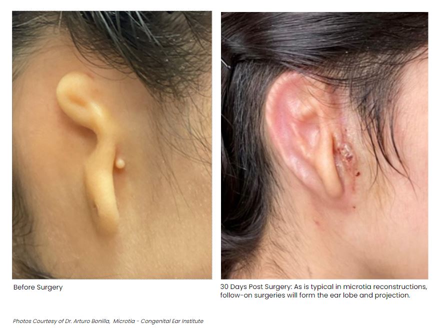 Doctors transplant 3D-printed ear made from human cells