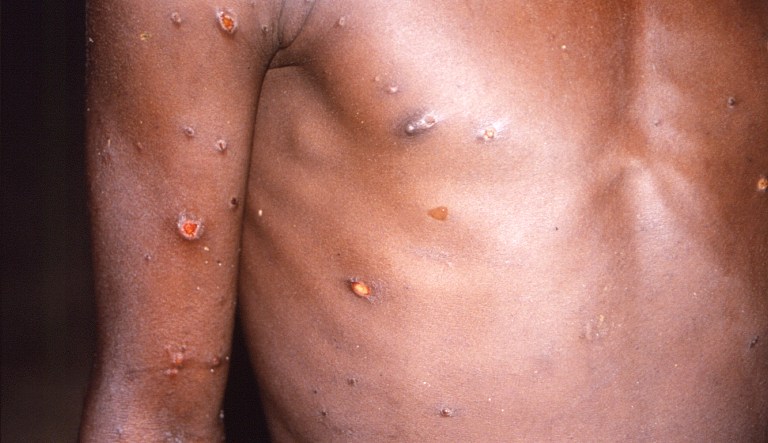 Lack of accessible monkeypox testing threatens response to outbreaks