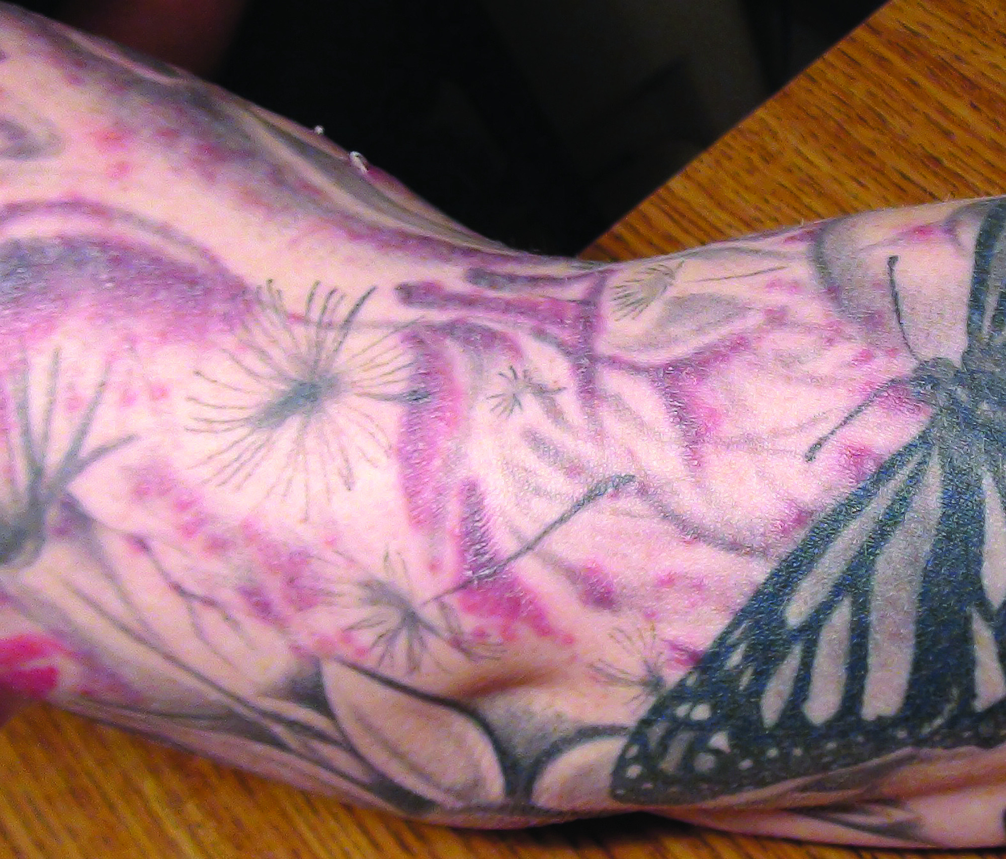 Study: Tattoo infections traced to tainted ink