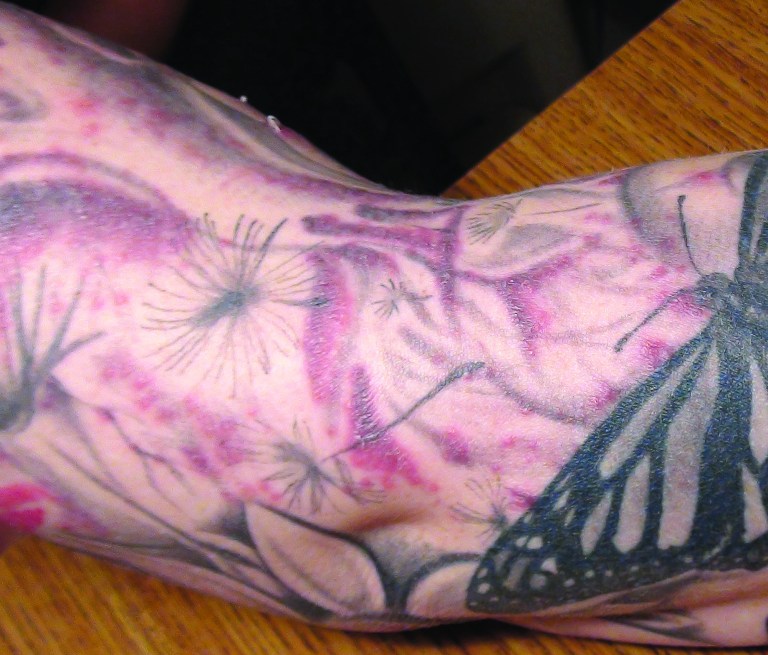 In this Jan 2012 photo provided by the Monroe County (N.Y.) Department of Public Health a persons arm is seen after receiving a tattoo covered with a red bubbly rash. As more people get tattoos, health officials are seeing more cases of a nasty skin infection blamed on the ink. In the largest outbreak reported, 19 people in Rochester, N.Y., recently ended up with bubbly rashes over their new tattoos. Cases also occurred in Colorado, Iowa and Washington States this year, health officials say. All together, the four states had 22 lab-confirmed tattoo-related infections and more than 30 suspected additional cases. (AP Photo/Monroe County (N.Y.) Department)