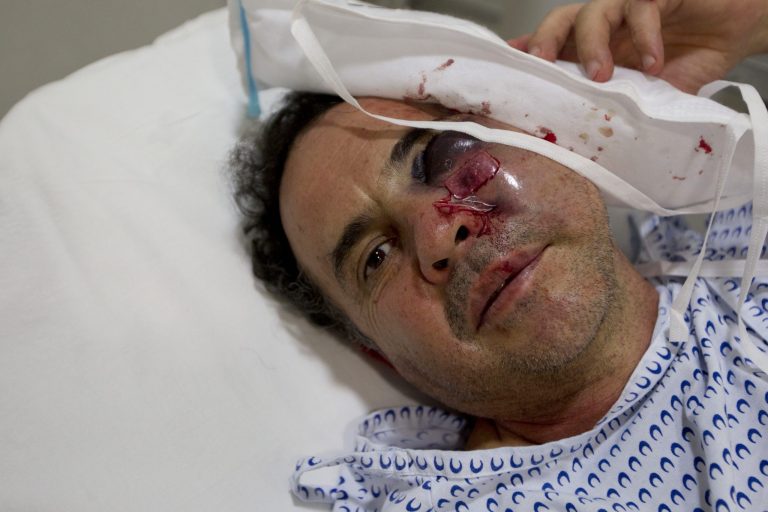 Associated Press freelance photographer Marco Ugarte looks into the camera as a nurse adjusts an ice pack on his face at a hospital in Mexico City, Tuesday, June 10, 2014. Ugarte suffered fractured facial bones when he was attacked by masked protesters on Tuesday while he was covering a march honoring students killed in government repression at a 1971 demonstration. Also injured were Paris Martinez of Animal Politico, Luis Castillo of the Reforma newspaper and freelancer Nestor Negrete. (AP Photo/Moises Castillo)