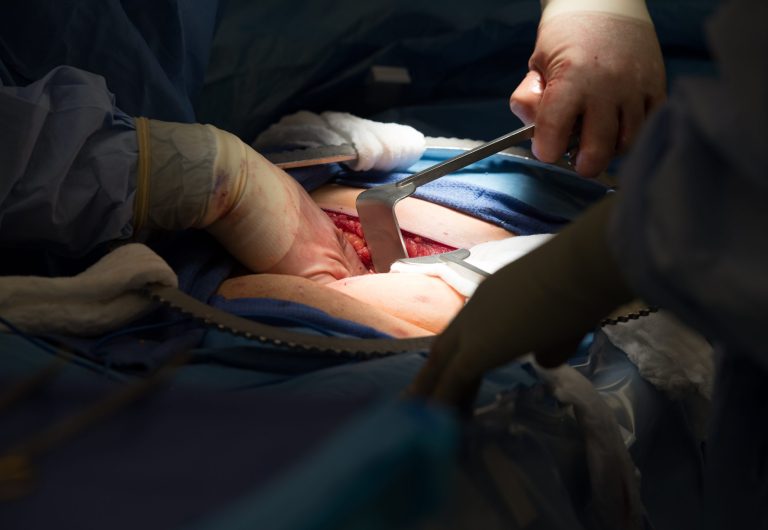 During a kidney transplant surgery at MedStar Georgetown University Hospital in Washington D.C., Tuesday, June 28, 2016.