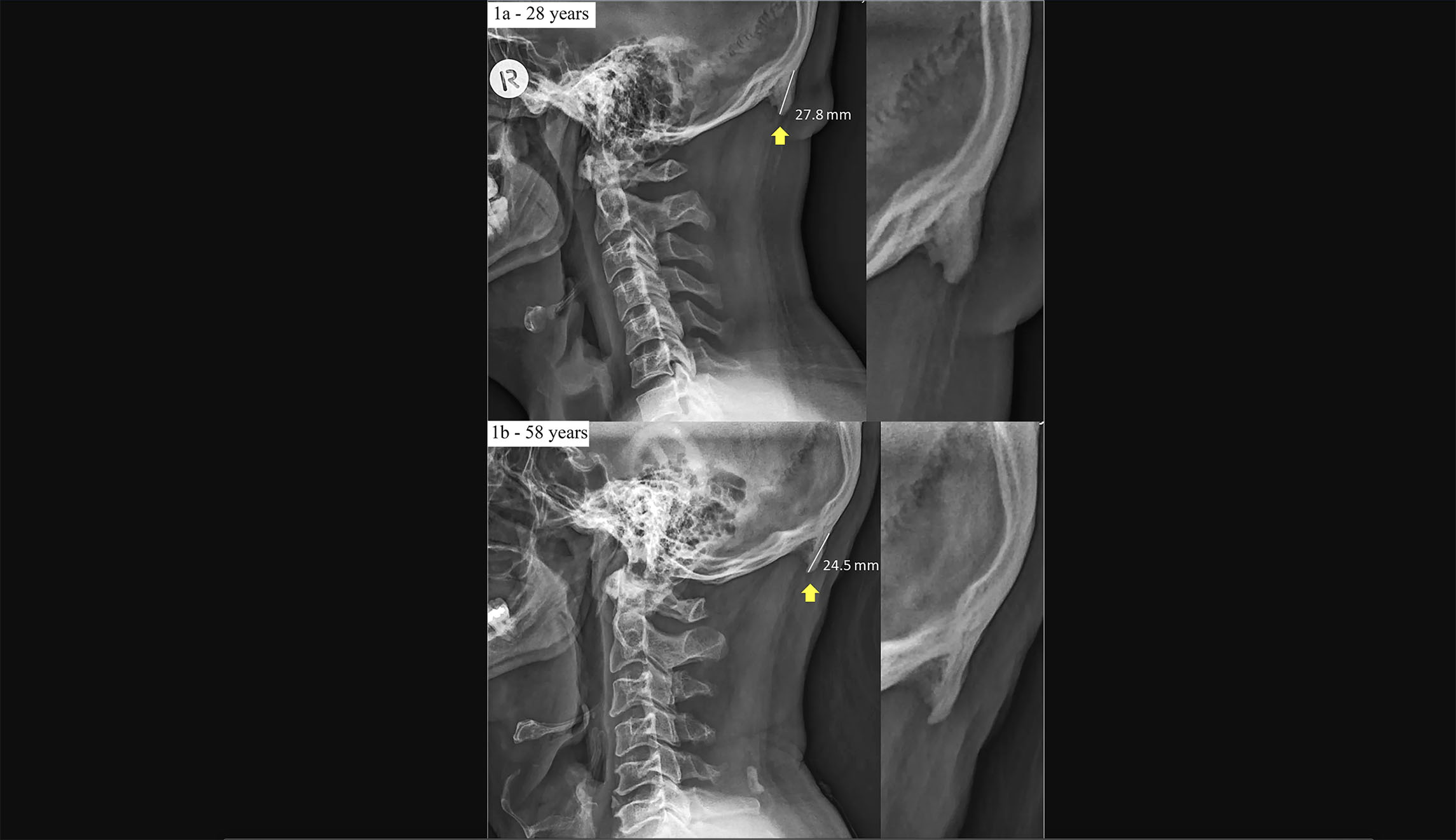 X-rays of two skulls are shown. A yellow arrow indicates the location of bone growth.