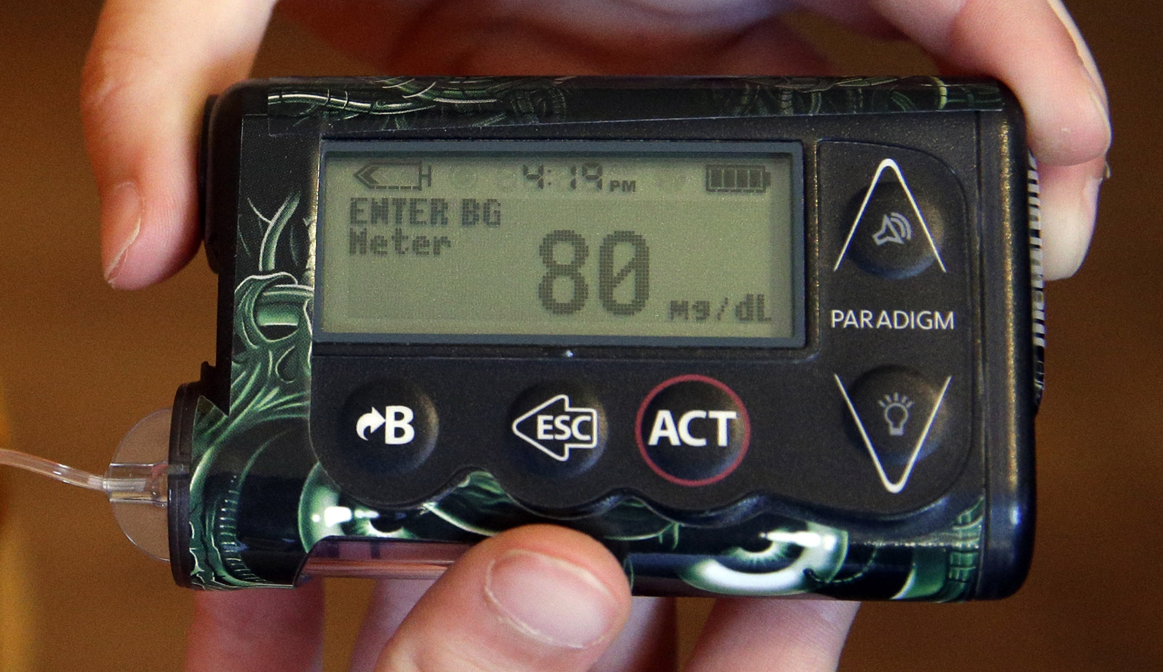 Deaths from diabetes in US reach more than 100,000 for second year