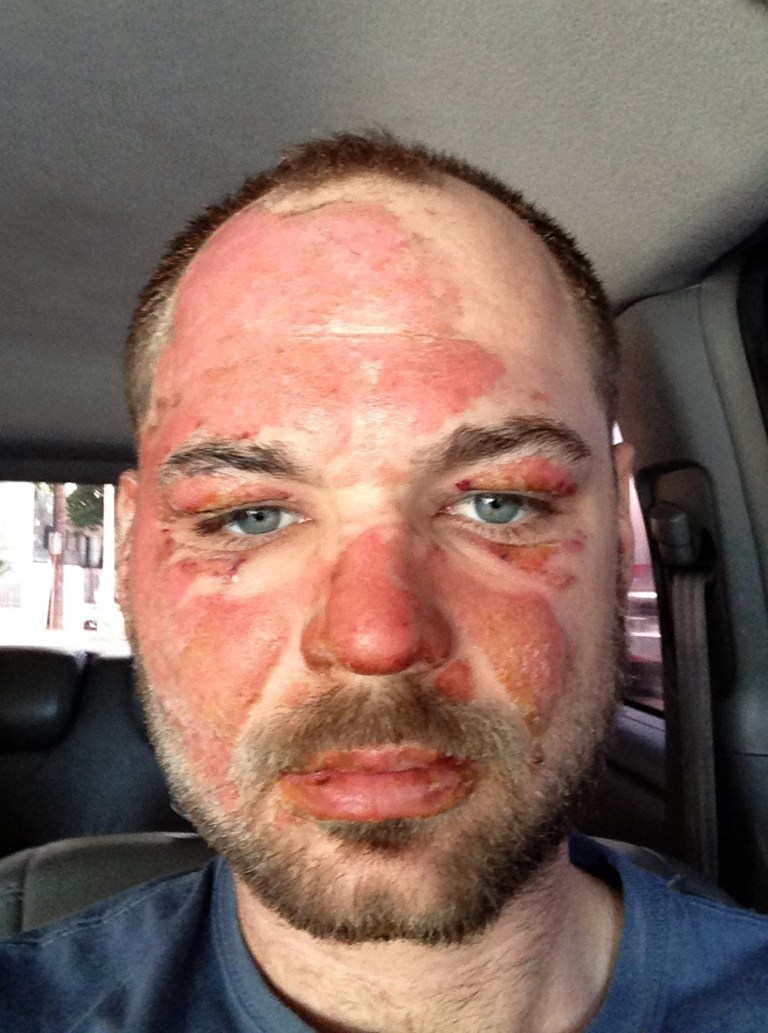   In this picture released by American magician Wayne Houchin, Houchin looks at the camera in Santo Domingo, Dominican Republic, Thursday, Nov. 29, 2012. Houchin, of Chico, California, is receiving treatment for burns after a local television show host lit his head on fire with a flammable cologne while taping his Nov. 26 appearance on the Dominican Republic's 