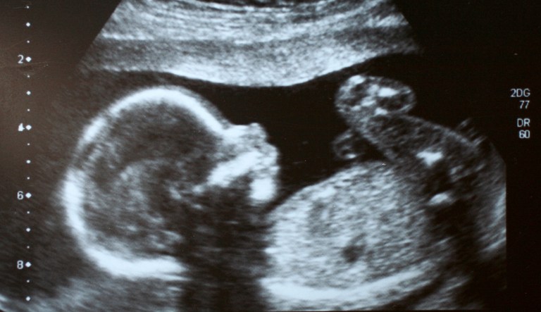 Ultrasound image of an unborn fetus.