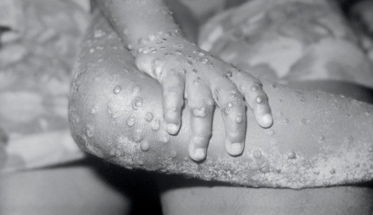 Monkeypox, a member of the orthopox family of viruses, is an infection accidentally transmitted to humans due to its similarity to the smallpox virus.