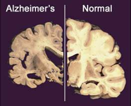 FILE - This undated file combo image provided by Merck & Co., shows a cross section of a normal brain, right, and one of a brain damaged by advanced Alzheimer's disease. Researchers said an experimental drug from the biotech company Genentech failed to slow mental decline in tests on more than 500 people with mild to moderate Alzheimer's disease. (AP Photo/Merck & Co., File)