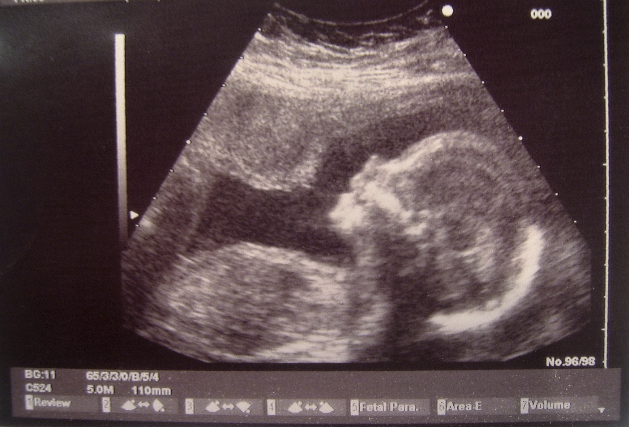 Two fundamental problems with wrongful-birth suits