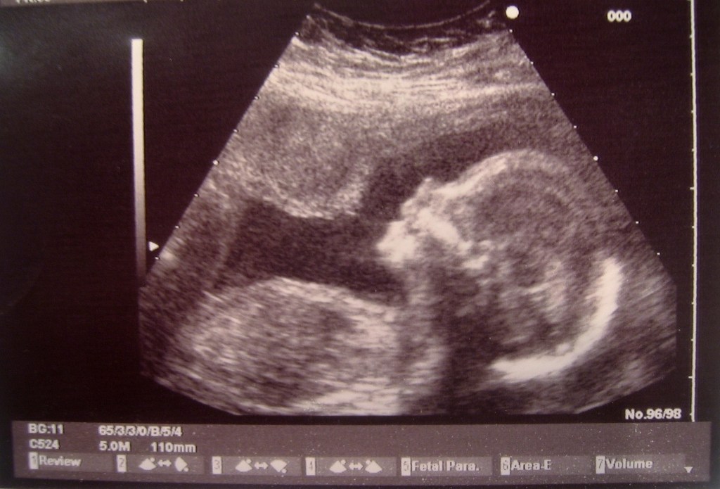 Two fundamental problems with wrongful-birth suits