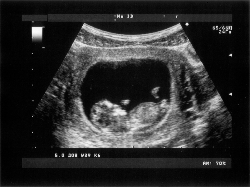 Ultrasound requirement struck down in North Carolina