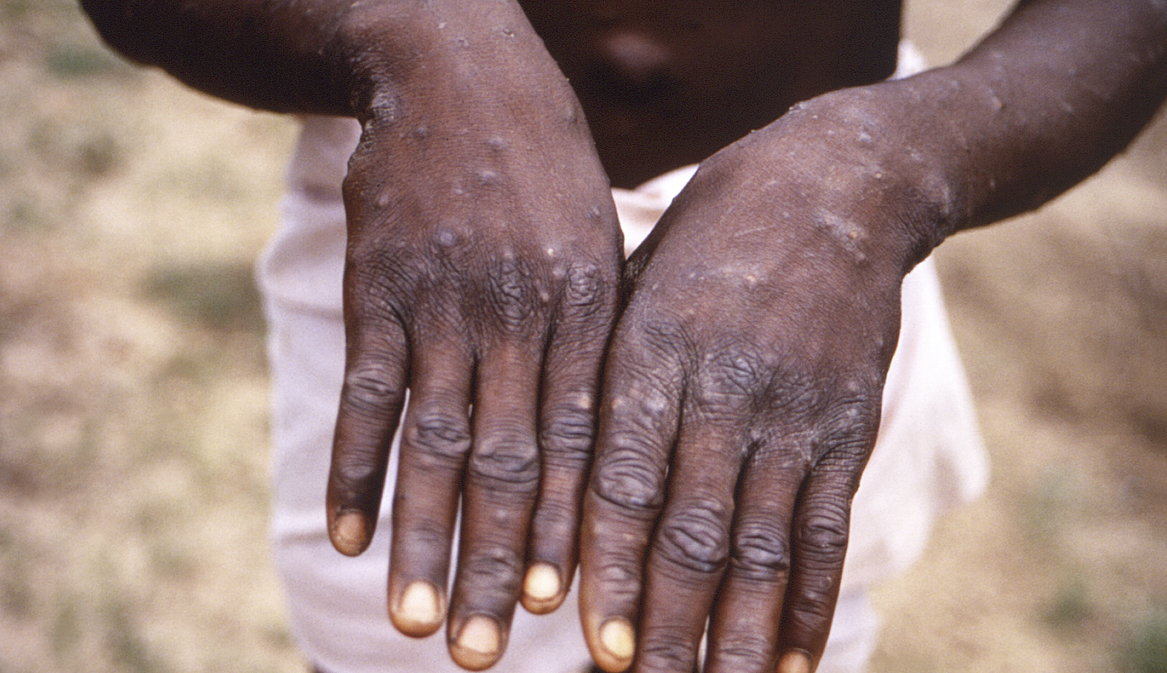 Two probable monkeypox cases detected in Utah