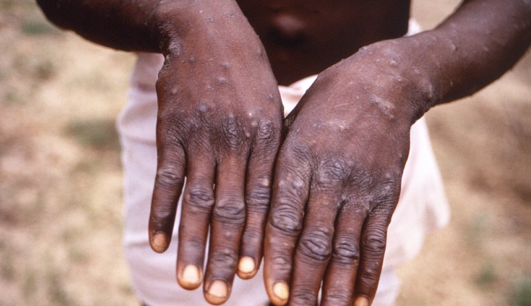 US monkeypox public health emergency imminent: Report