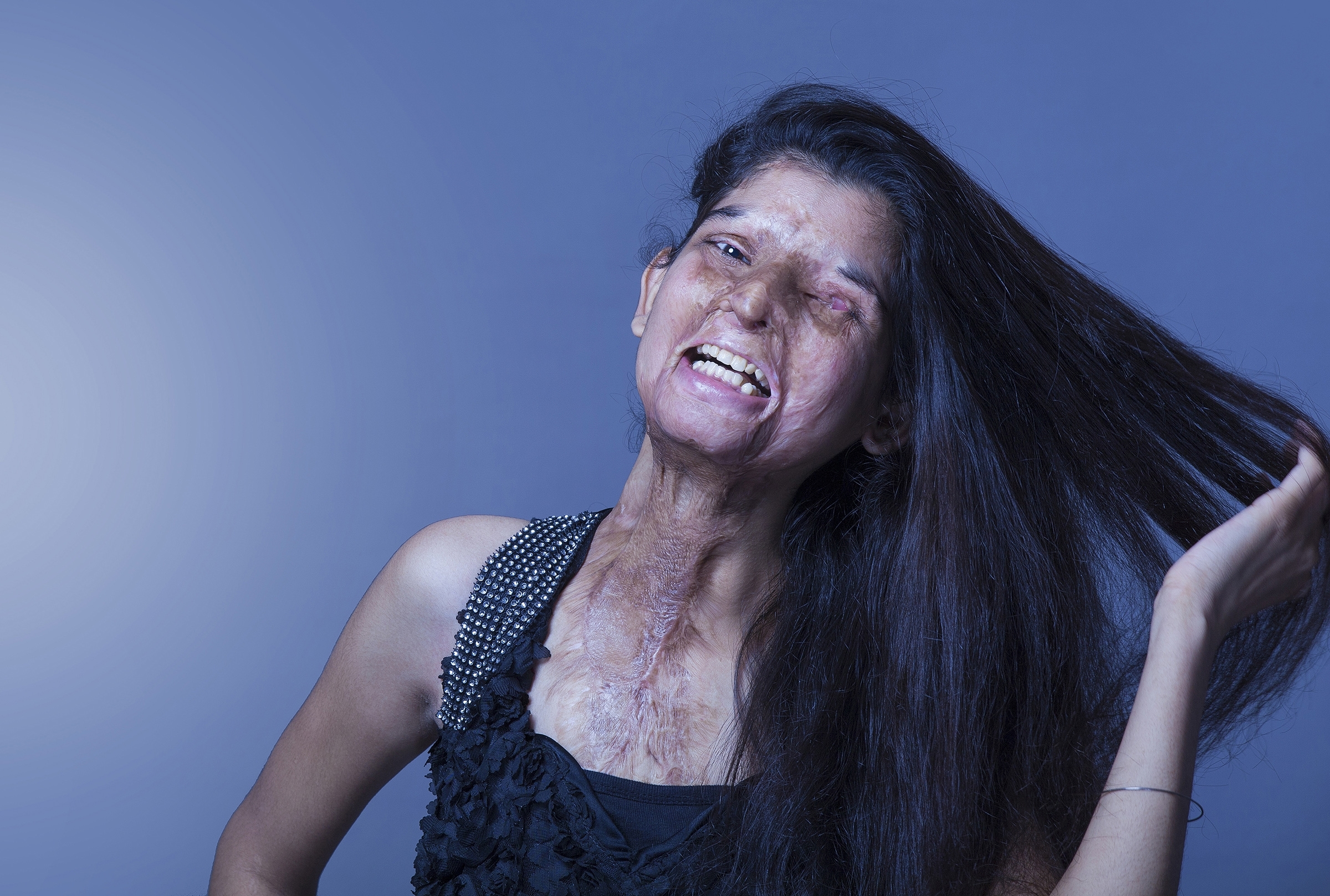 Acid victims’ photo shoot draws attention in India