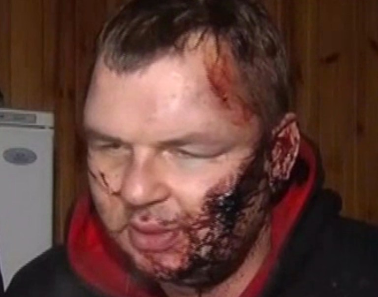 In this frame grab provided by 5 Channel, bloody Dmytro Bulatov speaks to press after he was found near Kiev, Ukraine, Jan. 31, 2014.  Bulatov, an opposition protester who disappeared more than a week ago says he was kidnapped and tortured by unknown assailants, in a chilling development that is likely to further stoke anger against the embattled government of President Viktor Yanukovych. Dmytro Bulatov, is the latest in a string of disappearances and mysterious attacks on prominent opposition leaders, which left one activist dead and several badly beaten. (AP Photo/5 Channel)