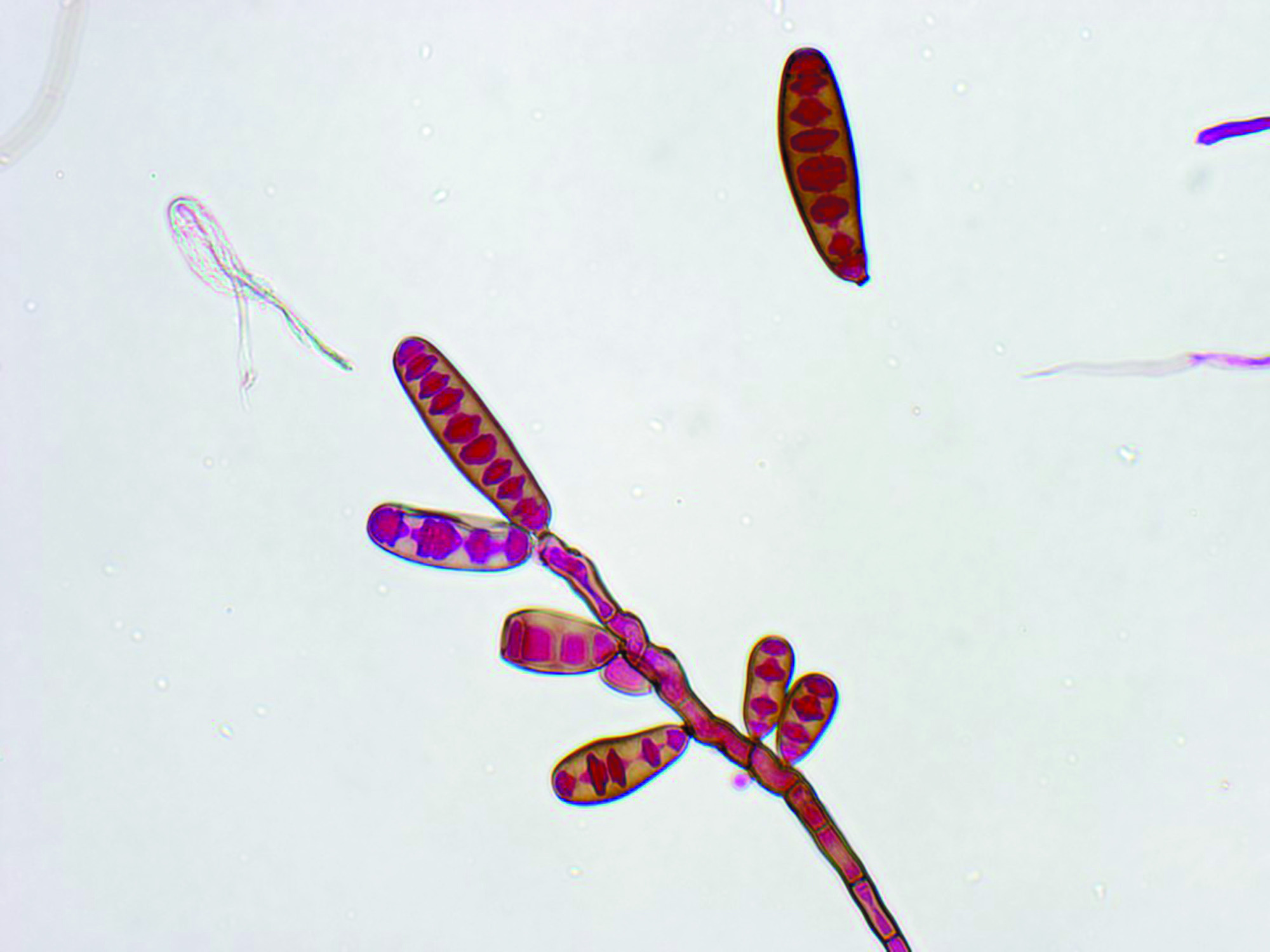 CDC: Meningitis outbreak growing, 14 people dead