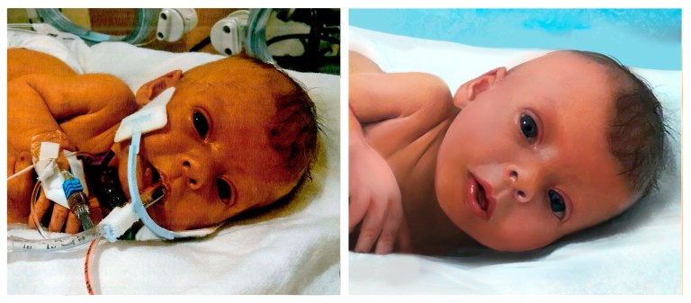 This combination photo of two images shows a family photo of Sophia Steffel, left, and a retouched version by Jillian Johnston of Mountain View, Calif. Days after the infant daughter of Nathen Steffel died in a Cincinnati hospital from complications from a tumor in her liver, he asked users on the Reddit website if someone could alter the hospital photo. 