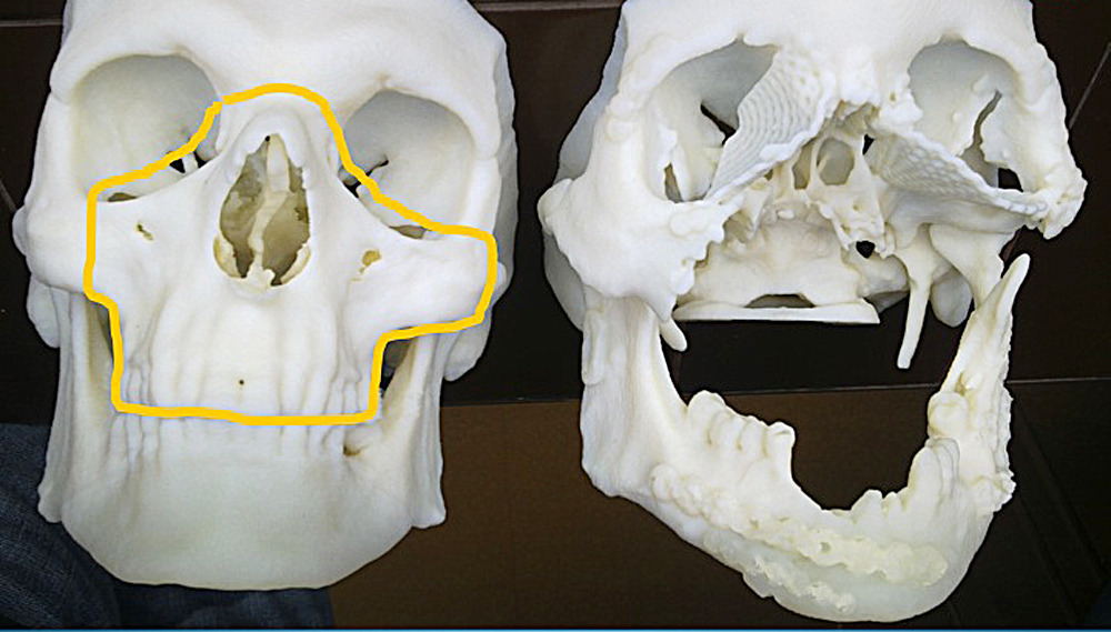 Polish man gets quick face transplant after injury