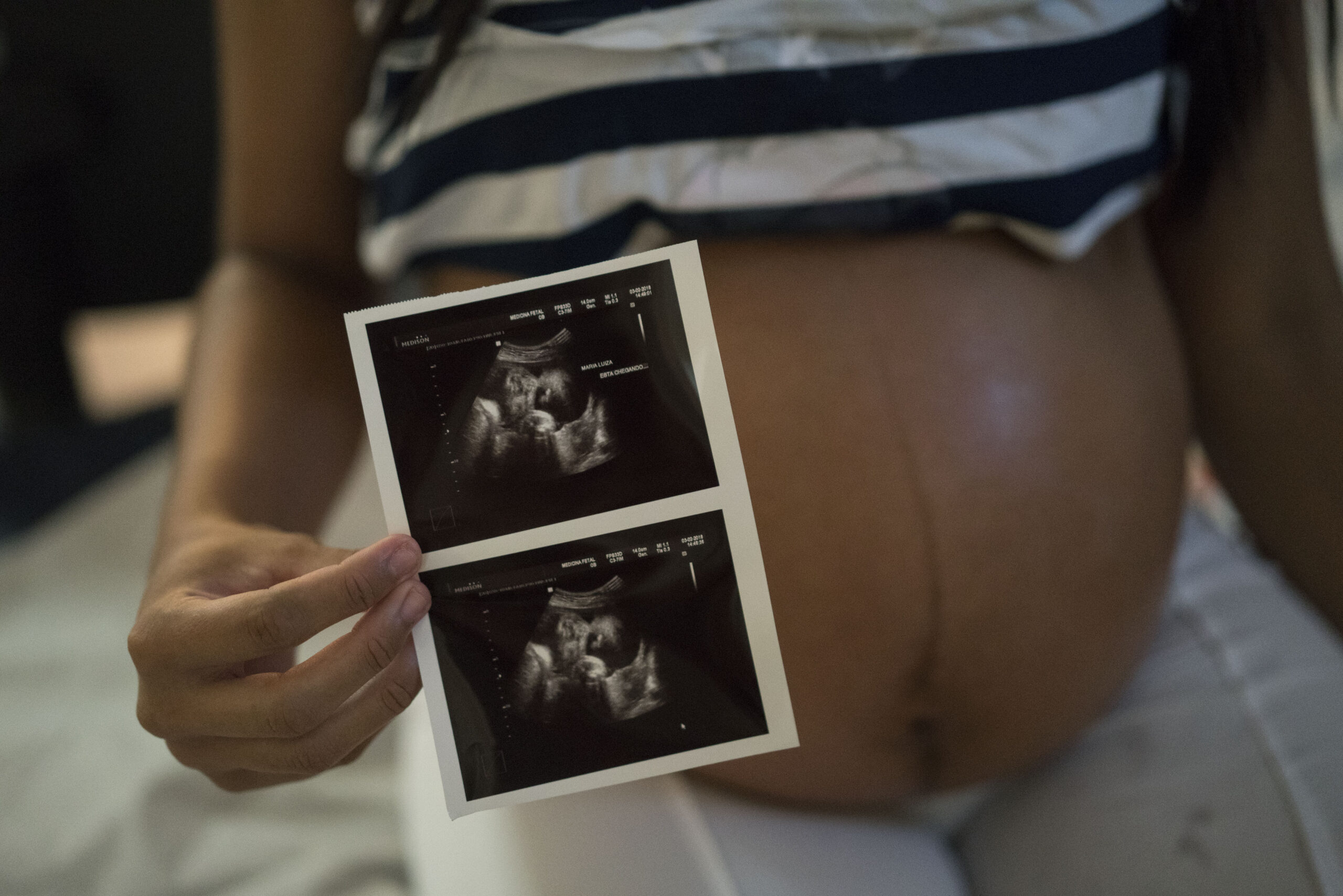 Zika may cause stillbirths