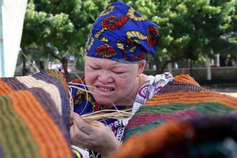 Albinos have long suffered discrimination in much of the world. (AP Photo/Khalfan Said)