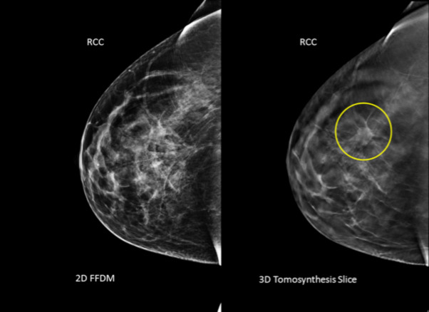 3-D mammogram scans may find more breast cancer