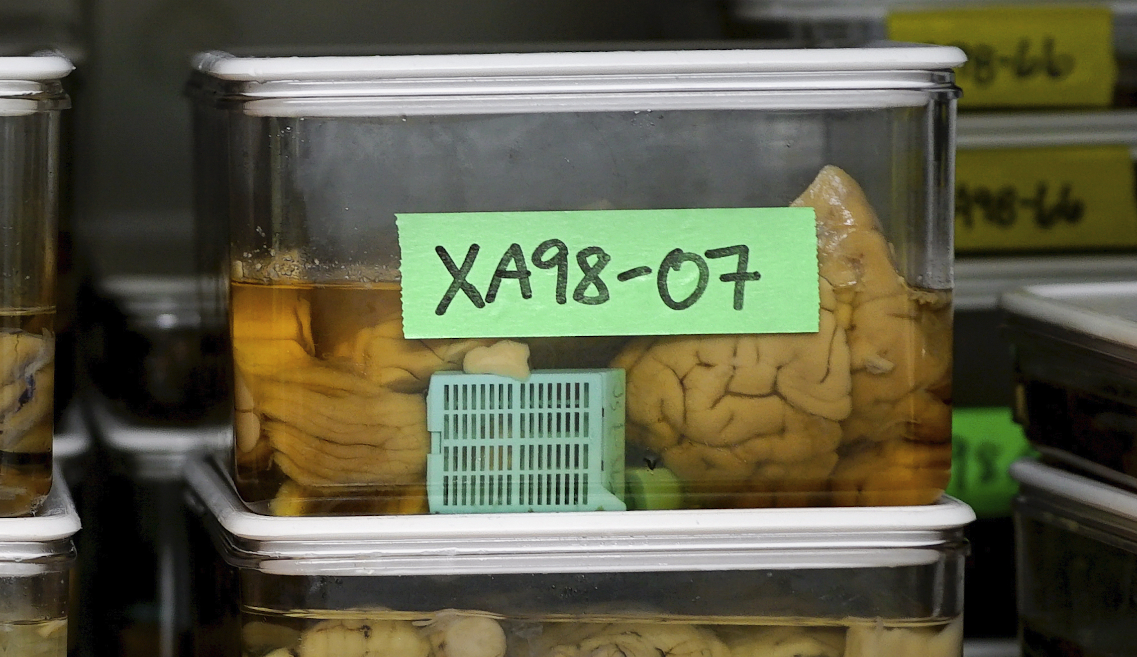 There’s a new Alzheimer’s wonder drug but don’t make Americans subsidize it for the whole world