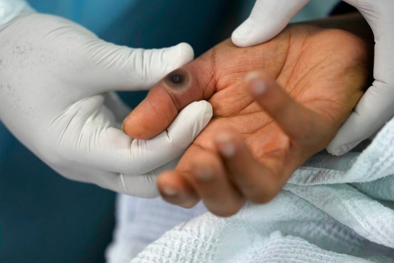 Doctors diagnose man with monkeypox, HIV, and COVID-19 in a day