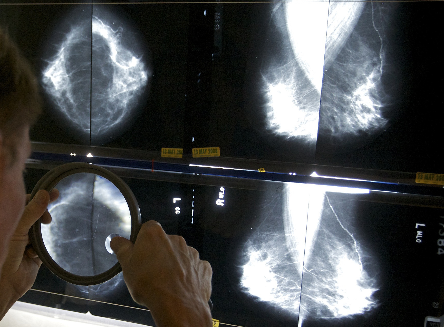 Task force proposes lowering mammogram starting age to 40