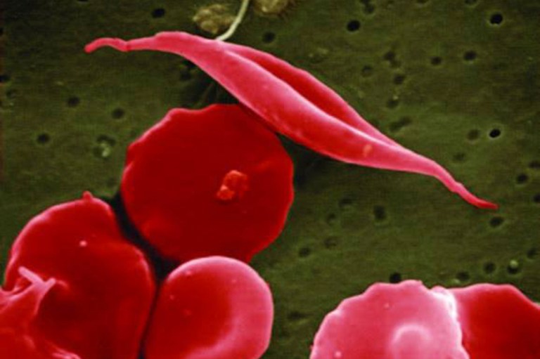 FDA approves world’s first CRISPR gene-editing drug for sickle cell disease