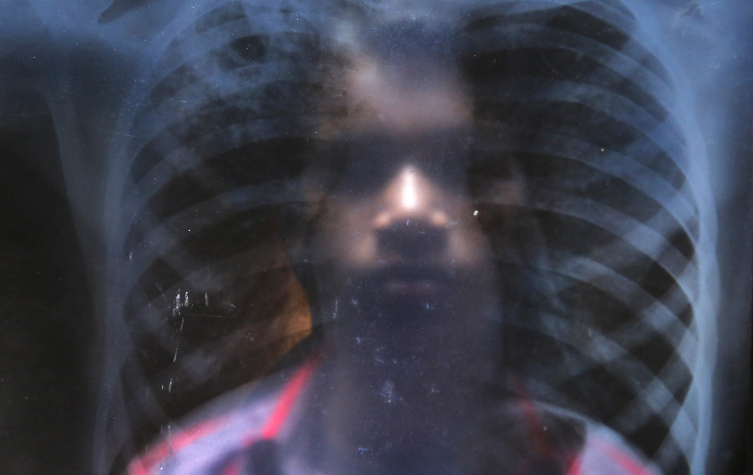 Weavers’ villages in India suffer TB epidemic