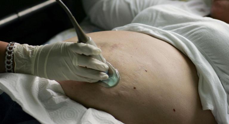 For all the claims about late-pregnancy abortions, there’s little data