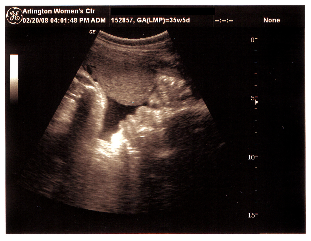 Senate to Vote on 20-Week Abortion Ban