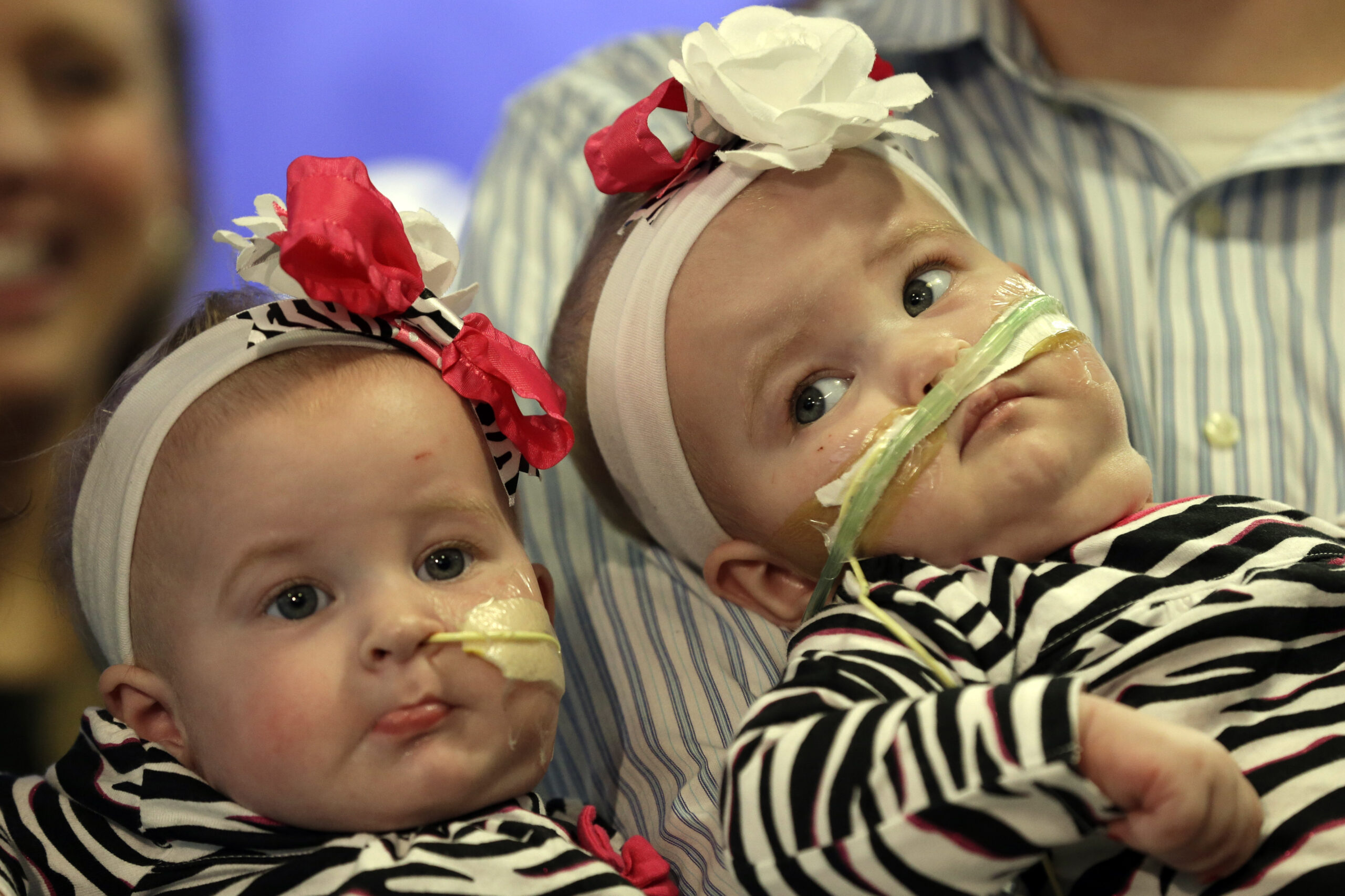 Once-conjoined NY twins make debut at Pa. hospital