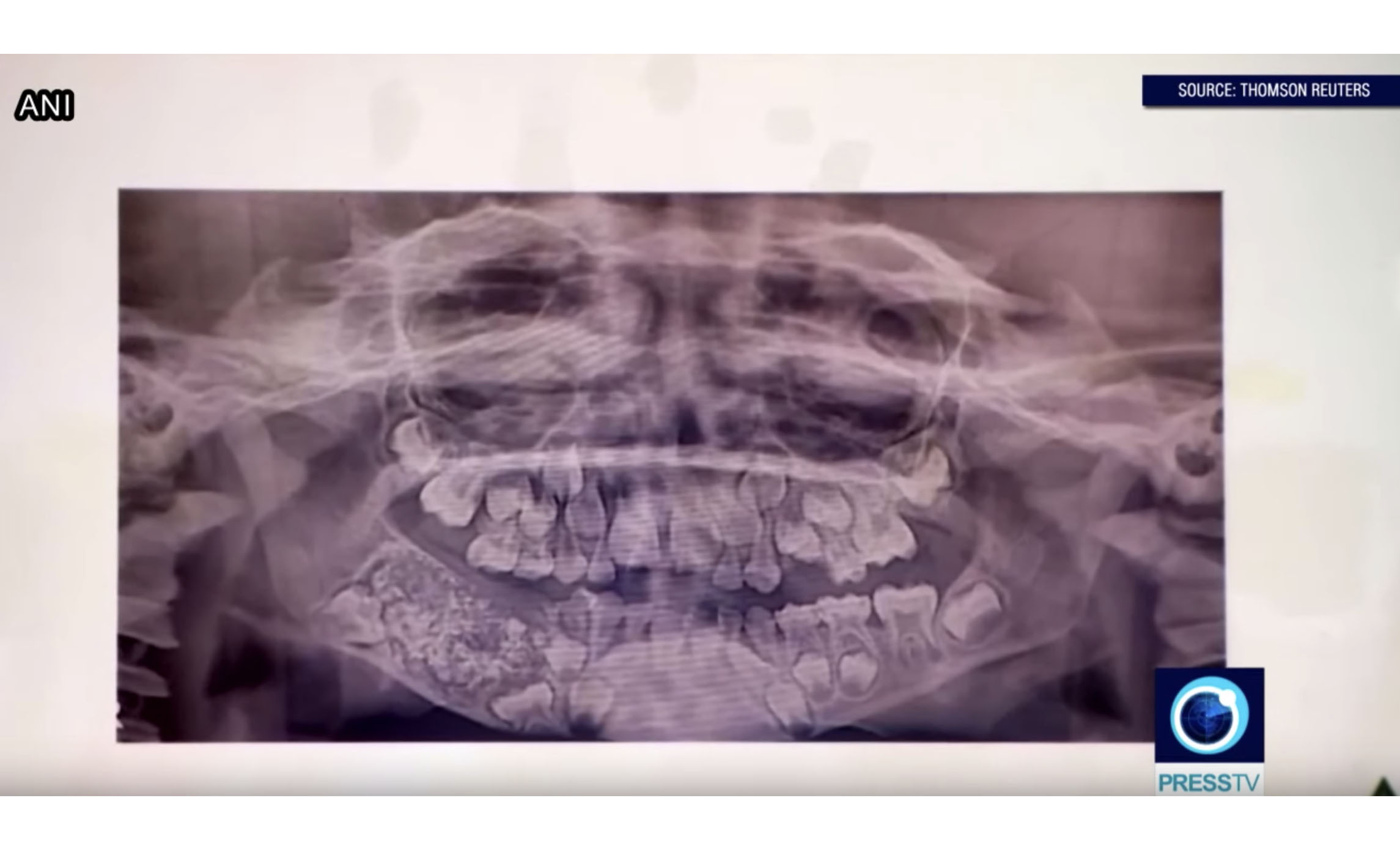 ‘Abnormal’: Doctors remove 526 teeth from child’s jaw