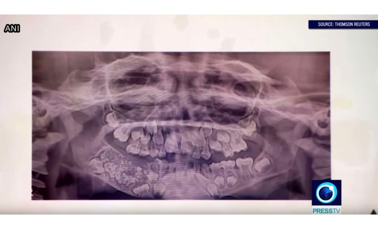 ‘Abnormal’: Doctors remove 526 teeth from child’s jaw