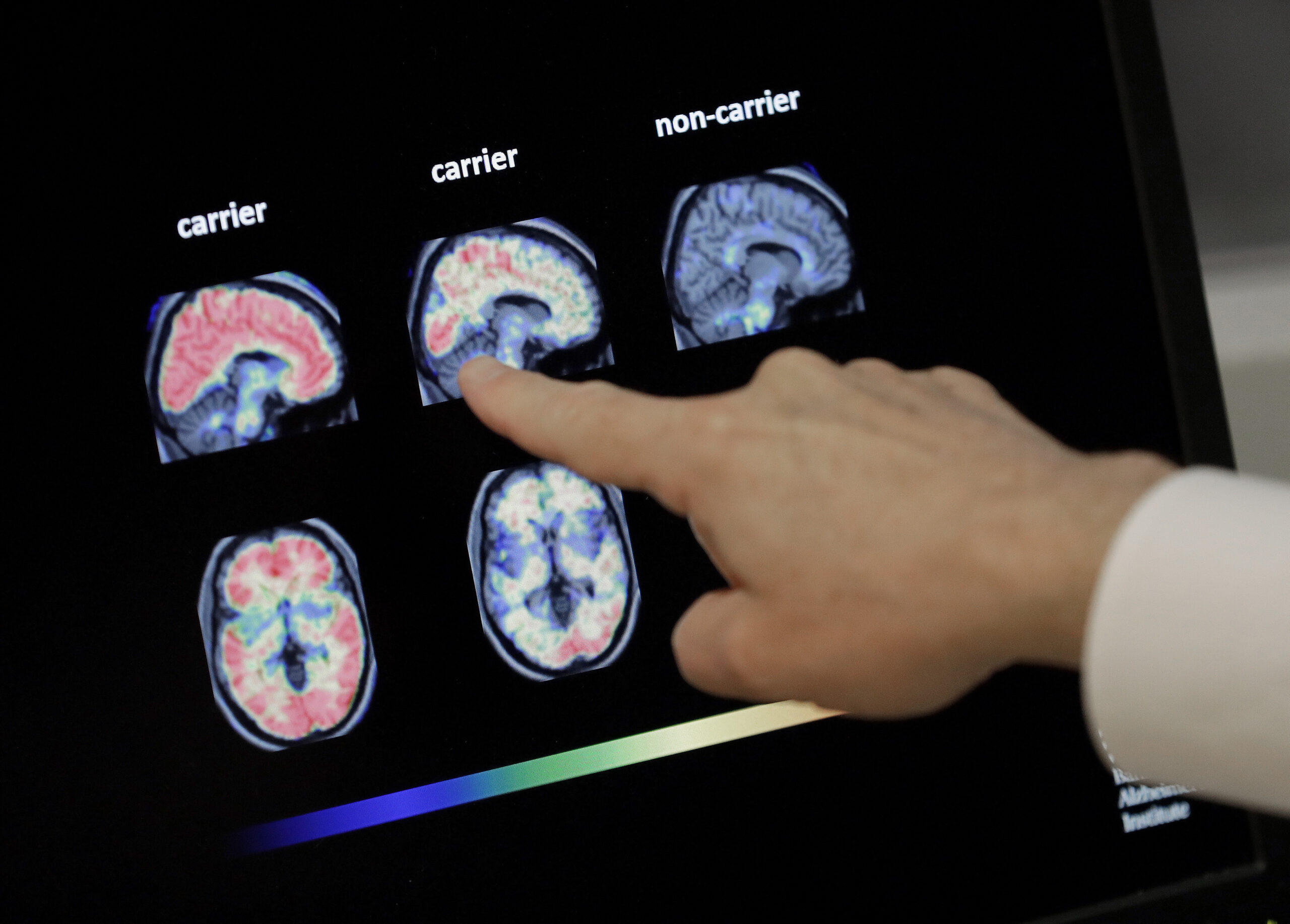 Early blood testing may predict dementia, research finds
