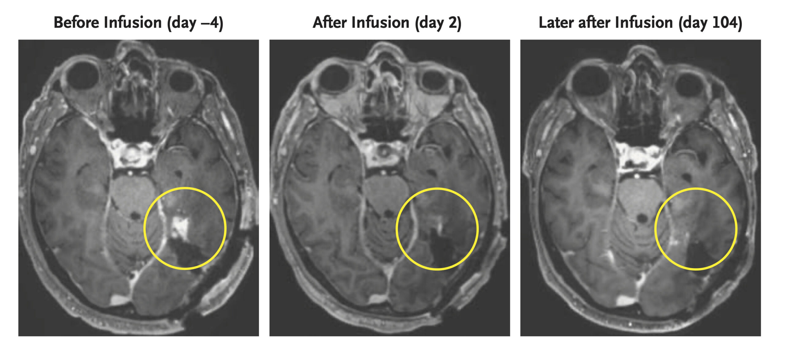 Cell therapy appears to shrink aggressive brain tumors