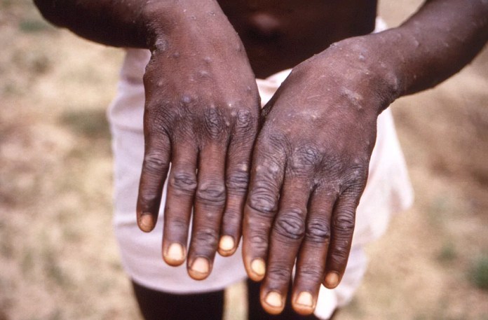 WHO considers declaring international health emergency over deadlier strain of mpox