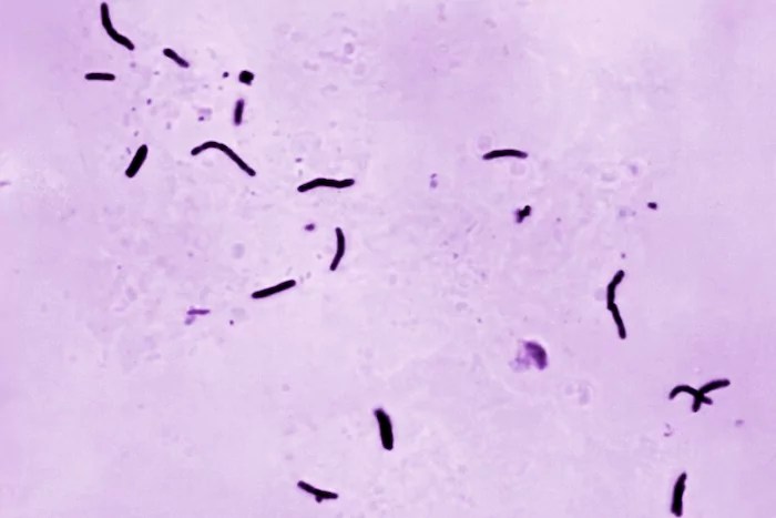 Kansas City area grapples with large tuberculosis outbreak