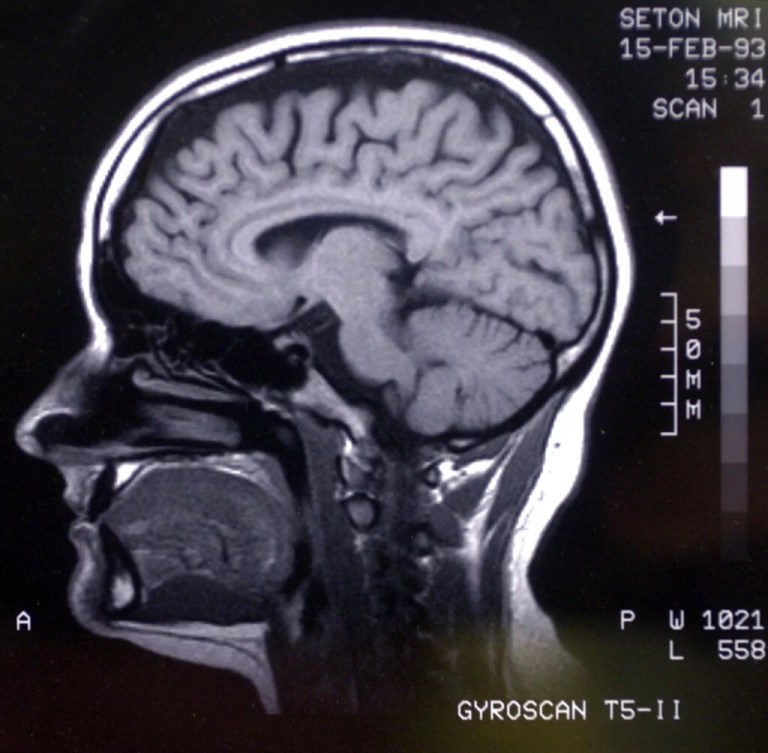 Scientists flag concerns over startling increase of microplastics in human brains