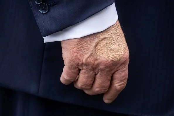 President Donald Trump's right hand is seen as he speaks to the press before boarding Marine One on the South Lawn of the White House on July 15, 2025, in Washington, DC. Trump is traveling to Pittsburgh, Pennsylvania, to speak at the Pennsylvania Energy and Innovation Summit on the campus of Carnegie Mellon University.