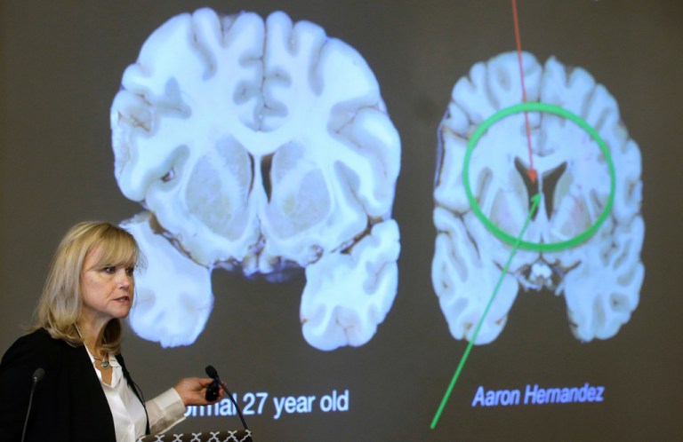 Ann McKee, director Boston University's center for research into the degenerative brain disease chronic traumatic encephalopathy, or CTE, addresses an audience on the school's campus Nov. 9, 2017 about the study of NFL football player Aaron Hernandez's brain, projected on a screen, behind right, in Boston.