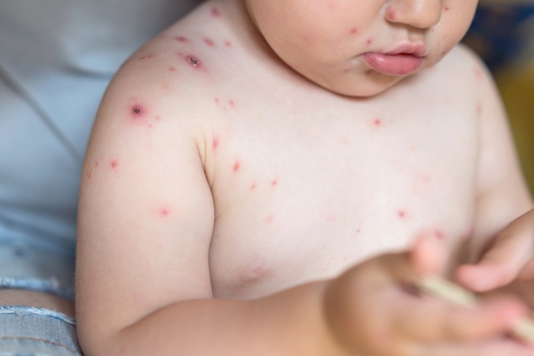 Front view image of baby girl with chickenpox rash