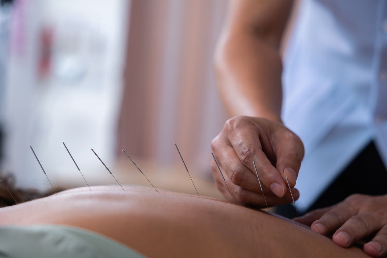 Acupuncture industry receives welcome boost from NIH with new study