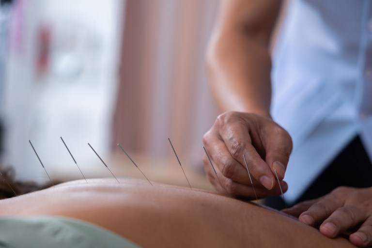 Acupuncturist stock image