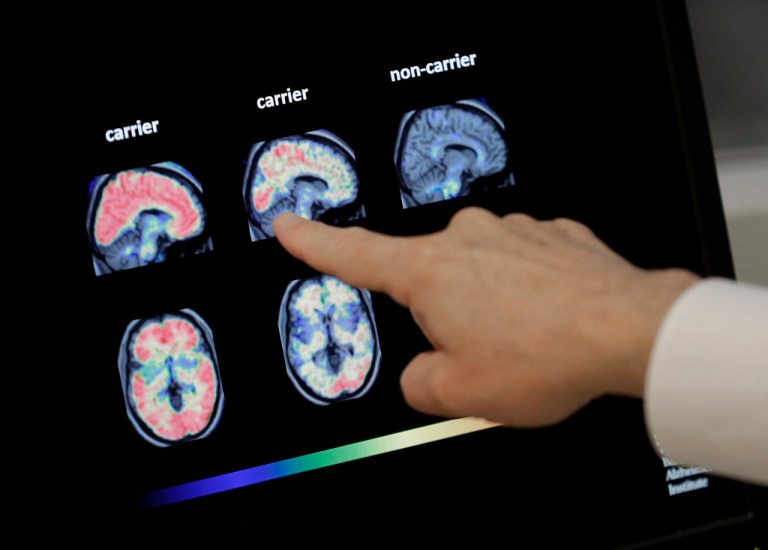 A doctor looks at PET brain scans at Banner Alzheimers Institute in Phoenix on Aug. 14, 2018.